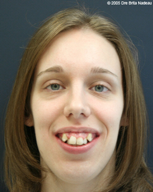 Marie-Hélène Cyr - Smile - Before orthodontic treatments and orthognathic surgeries (November 24, 2005)